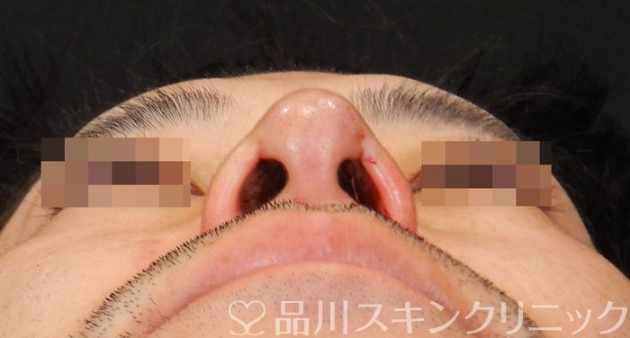 症例NO.64641のAFTER写真