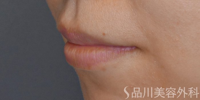症例NO.71350のBEFORE写真