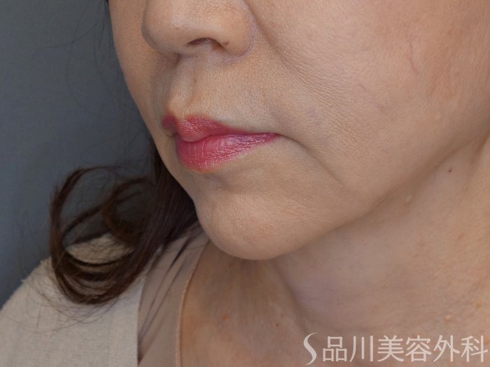 症例NO.71582のBEFORE写真