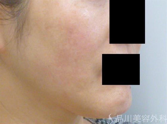 症例NO.22764のAFTER写真