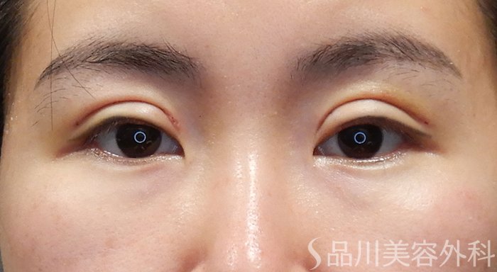 症例NO.69334のAFTER写真