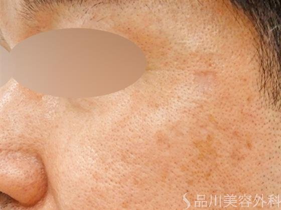 症例NO.57508のAFTER写真