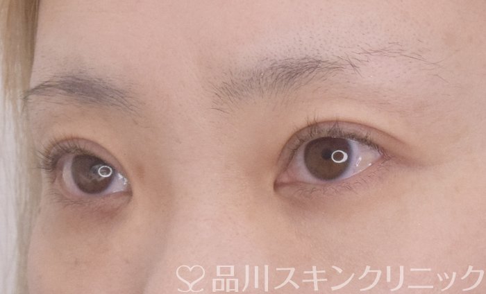症例NO.64812のAFTER写真