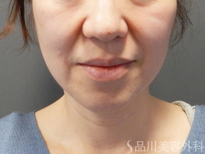 症例NO.75075のBEFORE写真