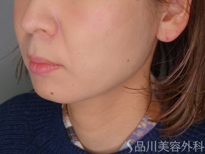症例NO.70584のAFTER写真