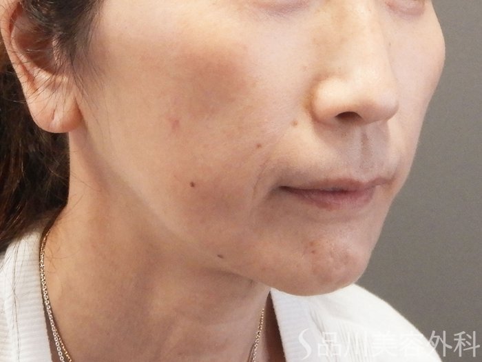 症例NO.65645のAFTER写真
