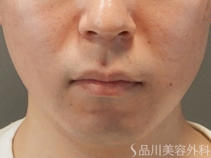 症例NO.69731のBEFORE写真