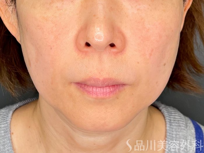 症例NO.73422のBEFORE写真