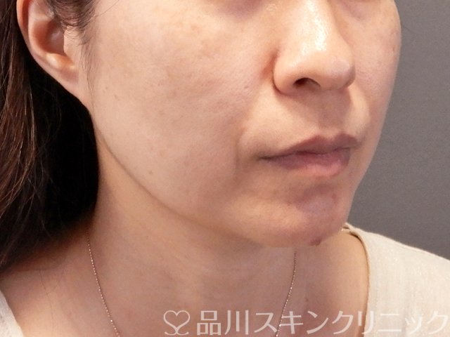 症例NO.67597のBEFORE写真