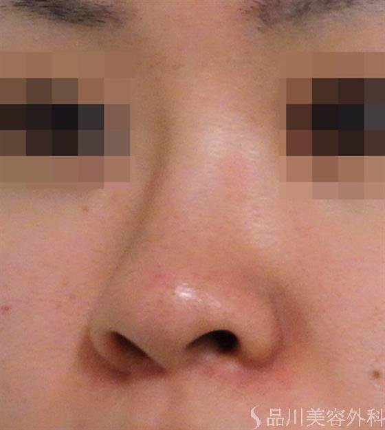 症例NO.37460のBEFORE写真