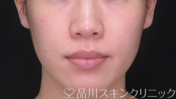 症例NO.71557のBEFORE写真