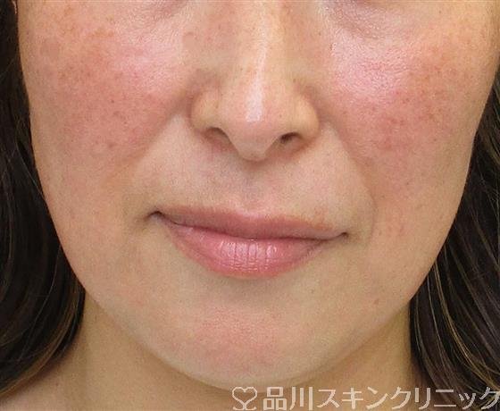 症例NO.58120のBEFORE写真
