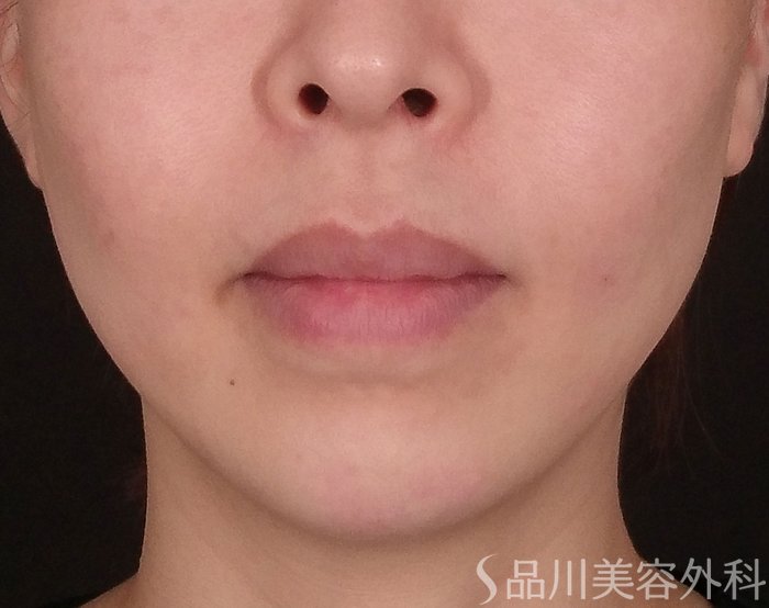 症例NO.69794のAFTER写真