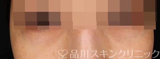 症例NO.74920のAFTER写真