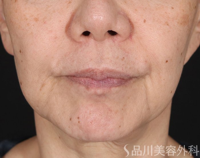 症例NO.71664のBEFORE写真