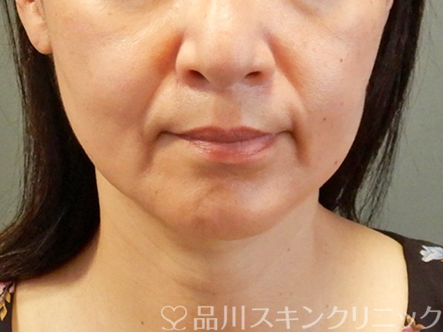 症例NO.66748のBEFORE写真