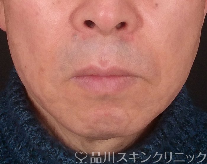 症例NO.69200のAFTER写真