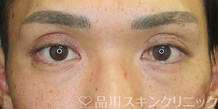 症例NO.73021のBEFORE写真