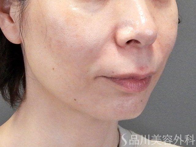 症例NO.69682のAFTER写真