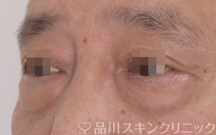 症例NO.70793のBEFORE写真