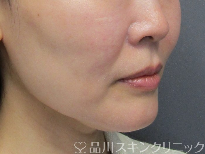 症例NO.75119のBEFORE写真