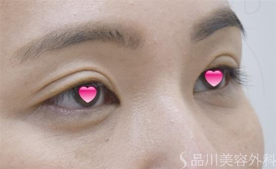 症例NO.52152のAFTER写真