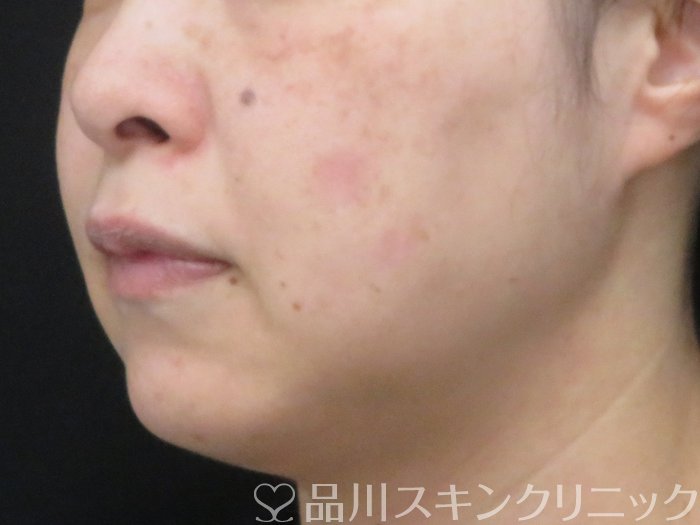 症例NO.69559のAFTER写真