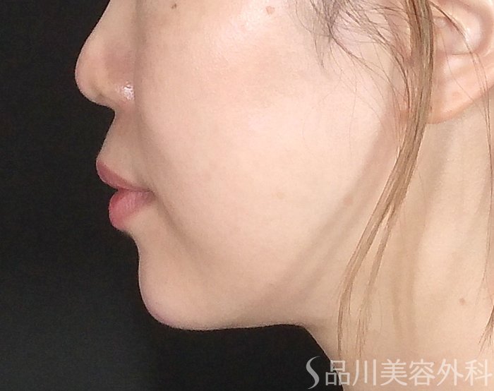 症例NO.64880のAFTER写真