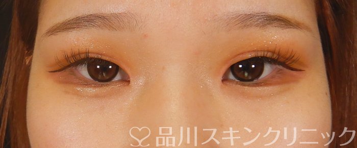 症例NO.63345のAFTER写真