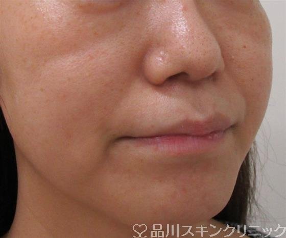 症例NO.37718のBEFORE写真