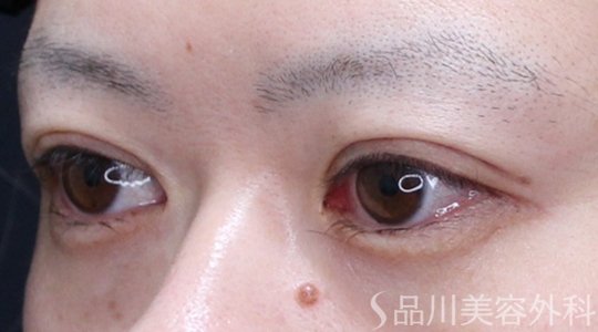 症例NO.74876のAFTER写真