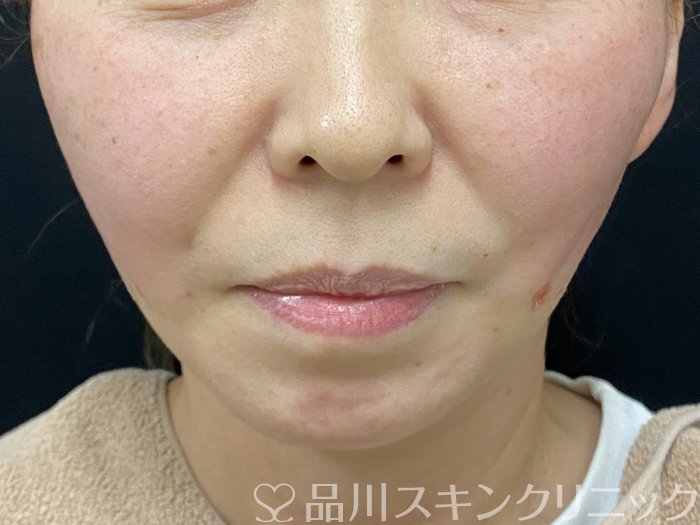 症例NO.74938のAFTER写真
