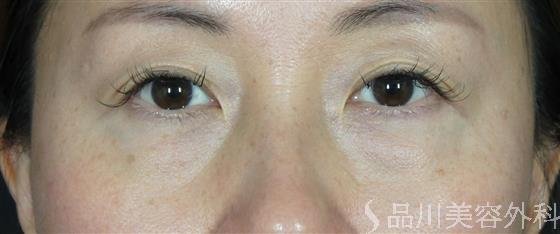 症例NO.61800のBEFORE写真
