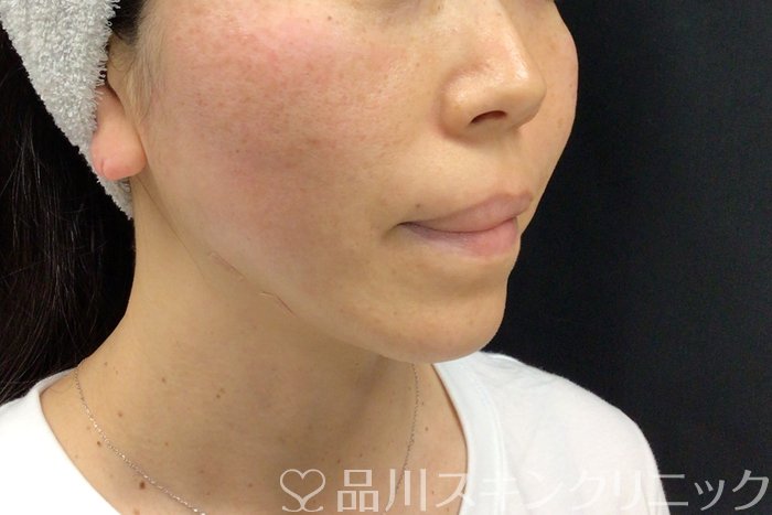 症例NO.71279のAFTER写真
