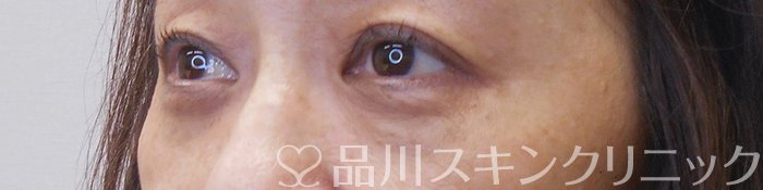 症例NO.70543のAFTER写真