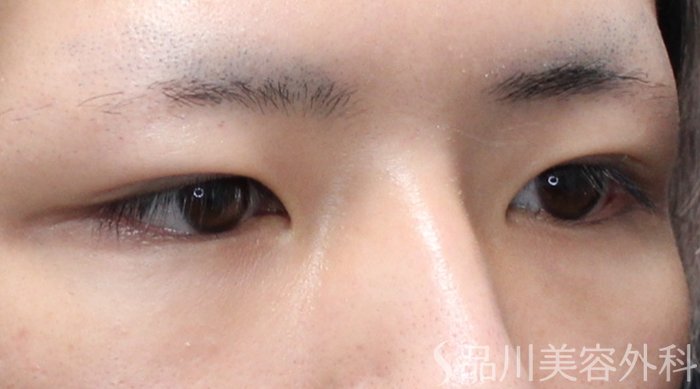 症例NO.75213のBEFORE写真
