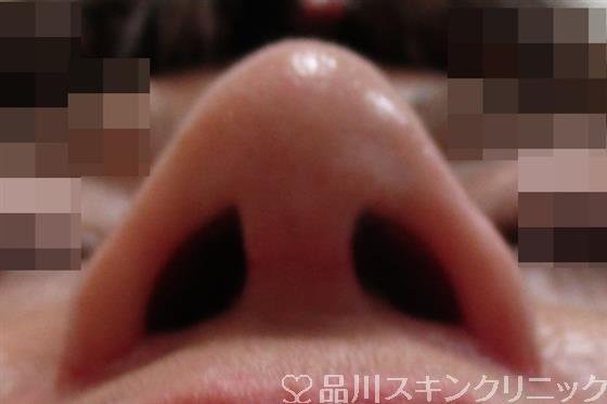 症例NO.33428のAFTER写真