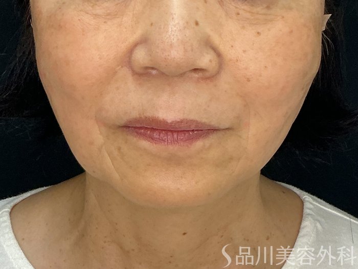 症例NO.71865のAFTER写真