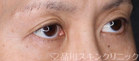 症例NO.72248のBEFORE写真