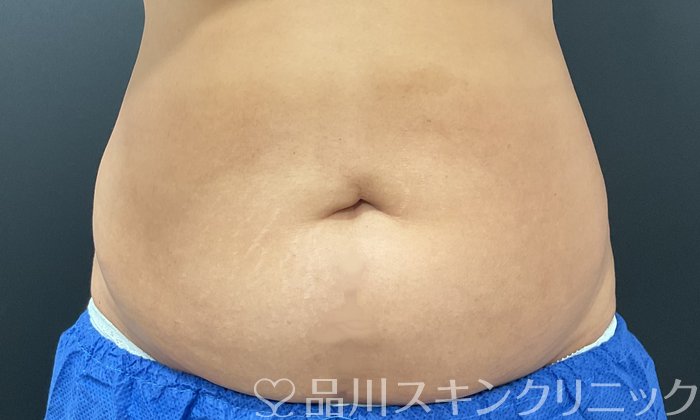 症例NO.74641のBEFORE写真