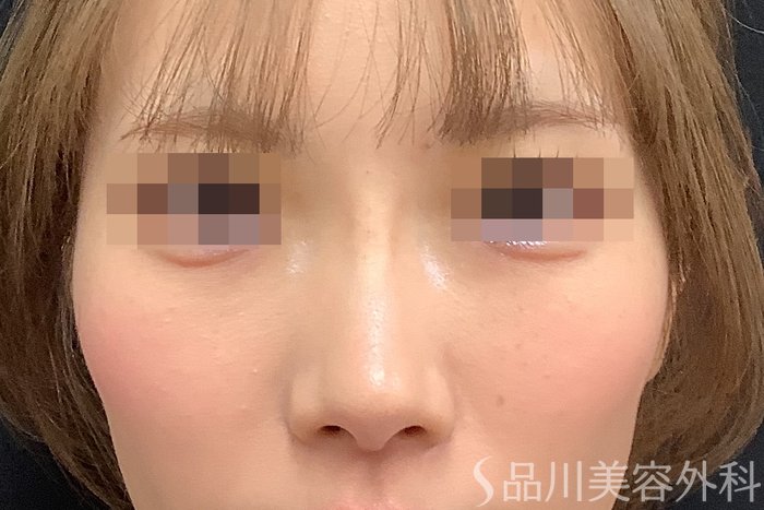 症例NO.71637のAFTER写真