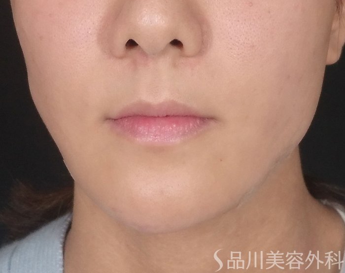 症例NO.69857のAFTER写真