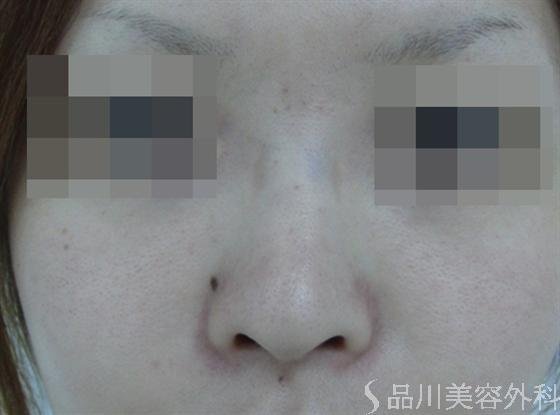 症例NO.14480のBEFORE写真