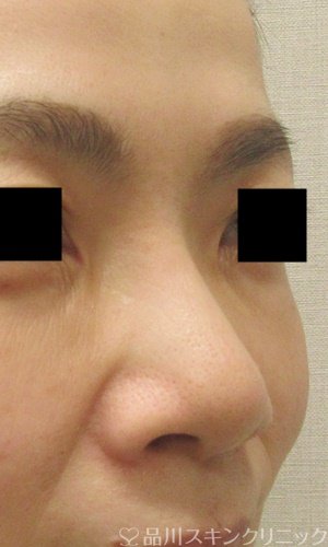 症例NO.69373のBEFORE写真