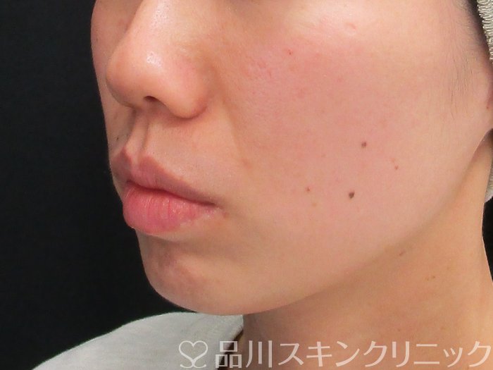 症例NO.72739のBEFORE写真