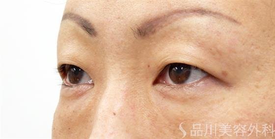症例NO.52085のBEFORE写真
