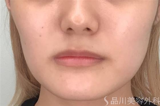 症例NO.56356のBEFORE写真
