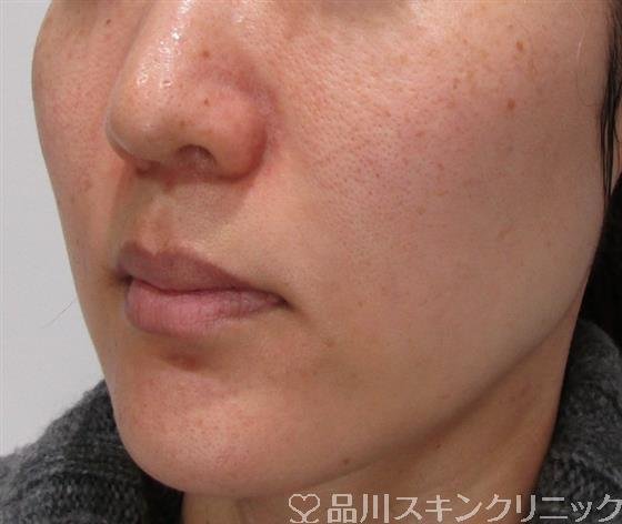 症例NO.32643のBEFORE写真