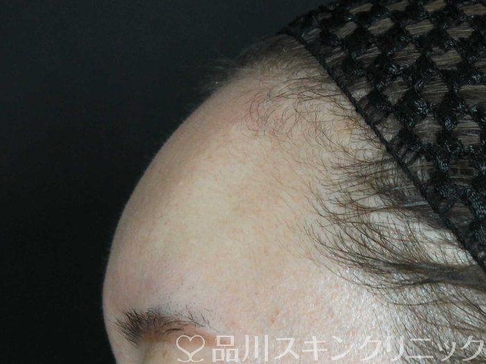 症例NO.70235のAFTER写真