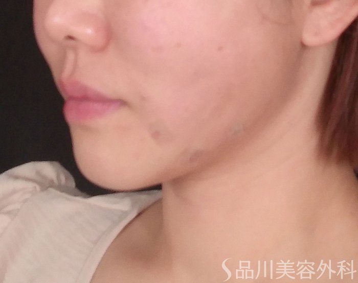 症例NO.69713のAFTER写真